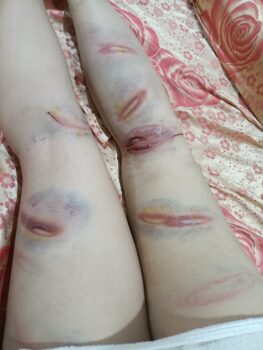 西港一女子遭暴力伤痕累累,母亲网上曝光讨公道-柬之窗